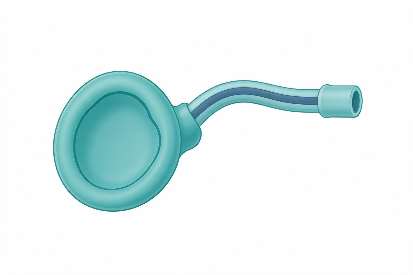 Laryngeal mask airway illustration (illustrative)